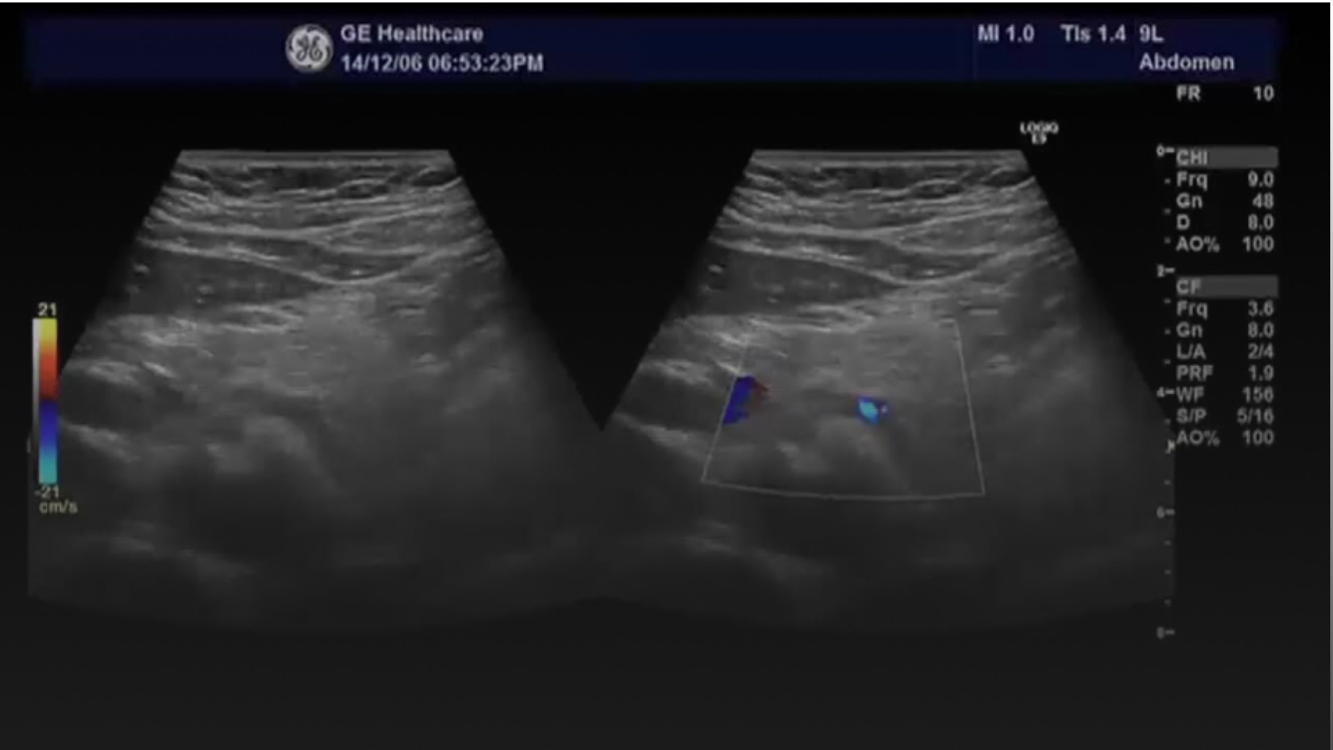 Pancreas | GE HealthCare (Japan)