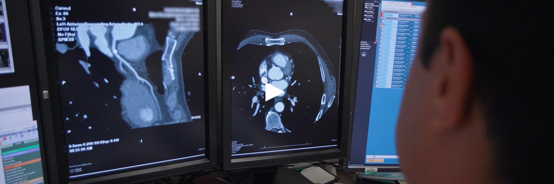 GEHCRevolutionAscendTrueFidelityImagesImage1-Video