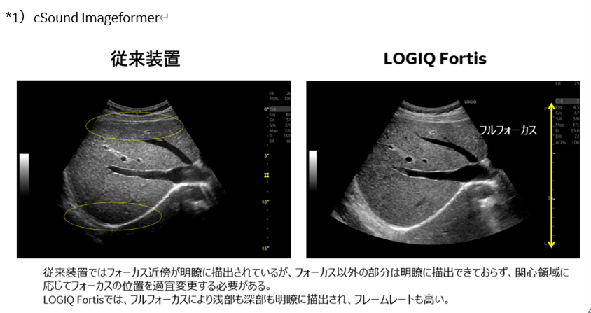 GEヘルスケア・ジャパン 汎用超音波画像診断装置 “LOGIQ Fortis”の販売