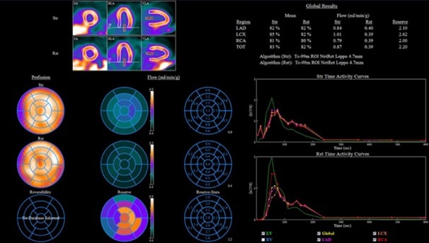 GEヘルスケア・ジャパン 心臓専用半導体SPECT装置 「MyoSPECT