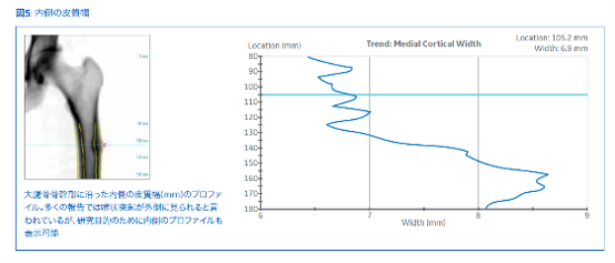 医学部パンフ 非定型骨折解析ソフト (AFF: Atypical Femur Fracture software) | GE