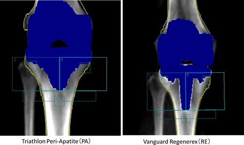 変形性膝関節症に対する人工膝関節置換術後の理学療法【DVD4枚組  