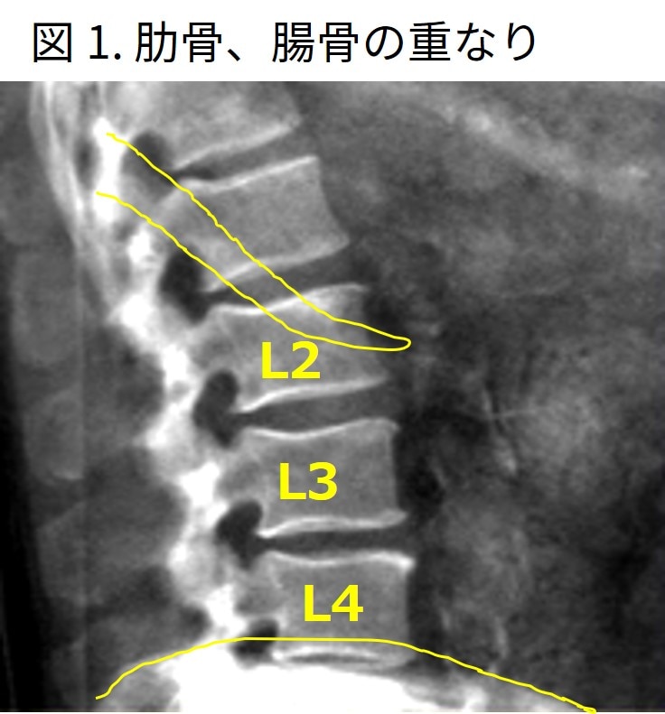図説腰椎の臨床 腰椎X線写真の読み方 (JIM 15巻10号) | 医書.jp
