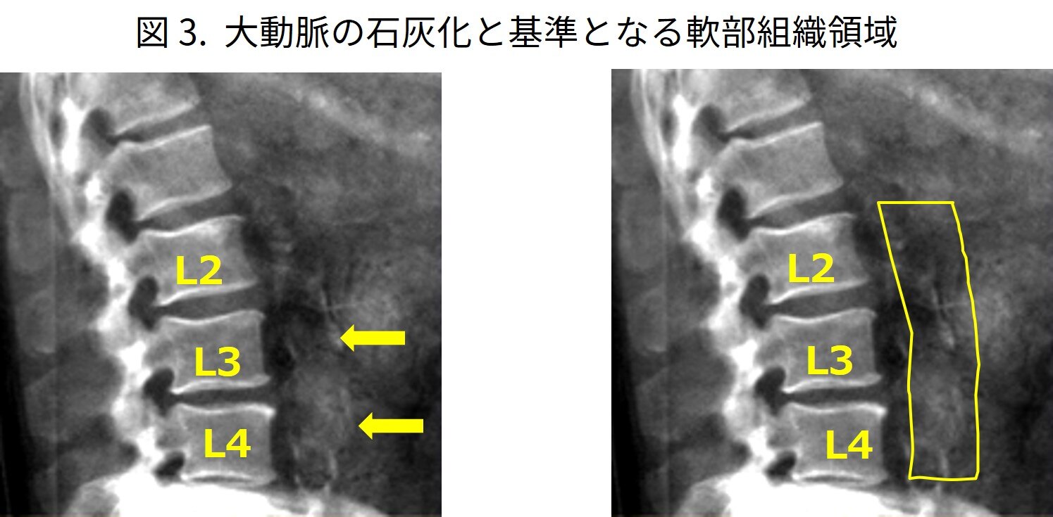 DXA法における腰椎側面骨密度に関して ‐装置メーカーとしての