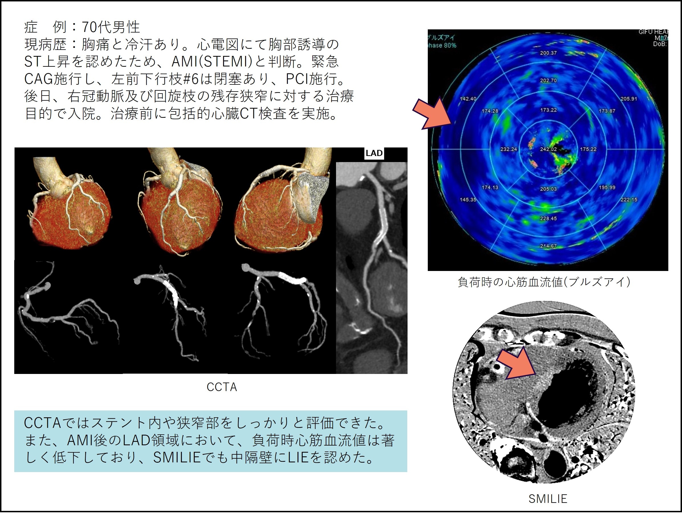 Revolution CTが実現する包括的心臓検査 | GE HealthCare (Japan)