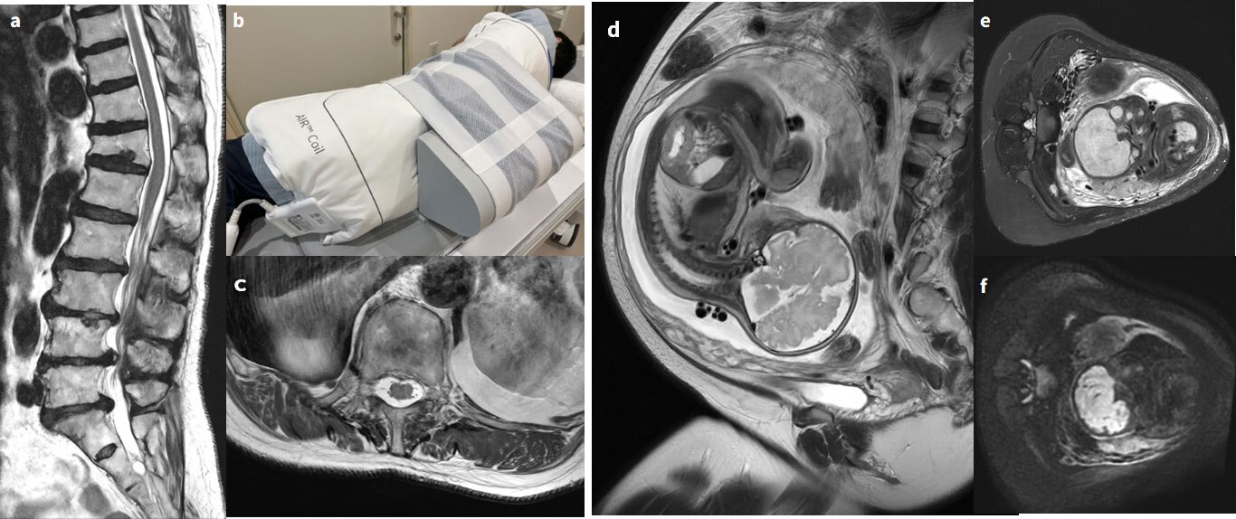 専用出品！mri〜様 希少疾患であるSENDA/BPANの診断として小児期のMRI画像が有効で