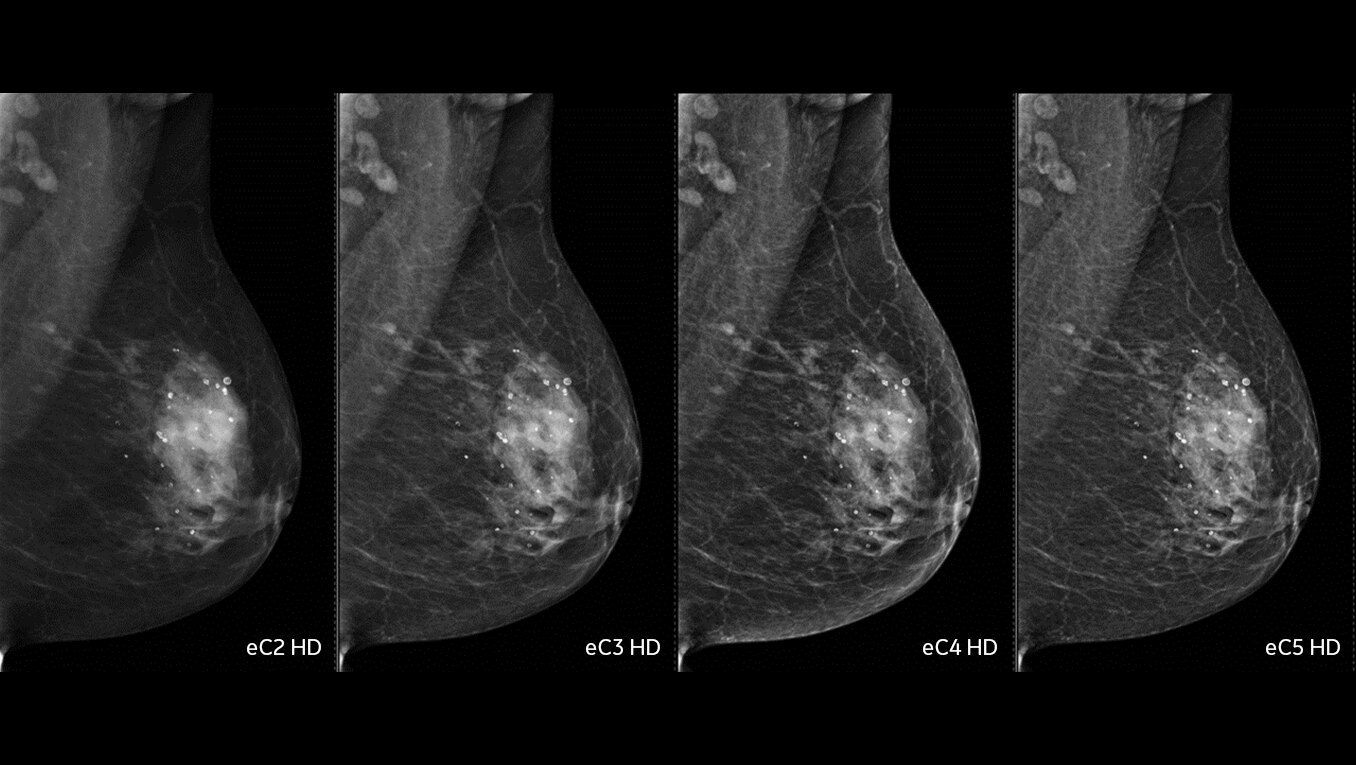 健康・医学 Preneoplasia of the Breast Pristina™ | GE HealthCare (Japan)