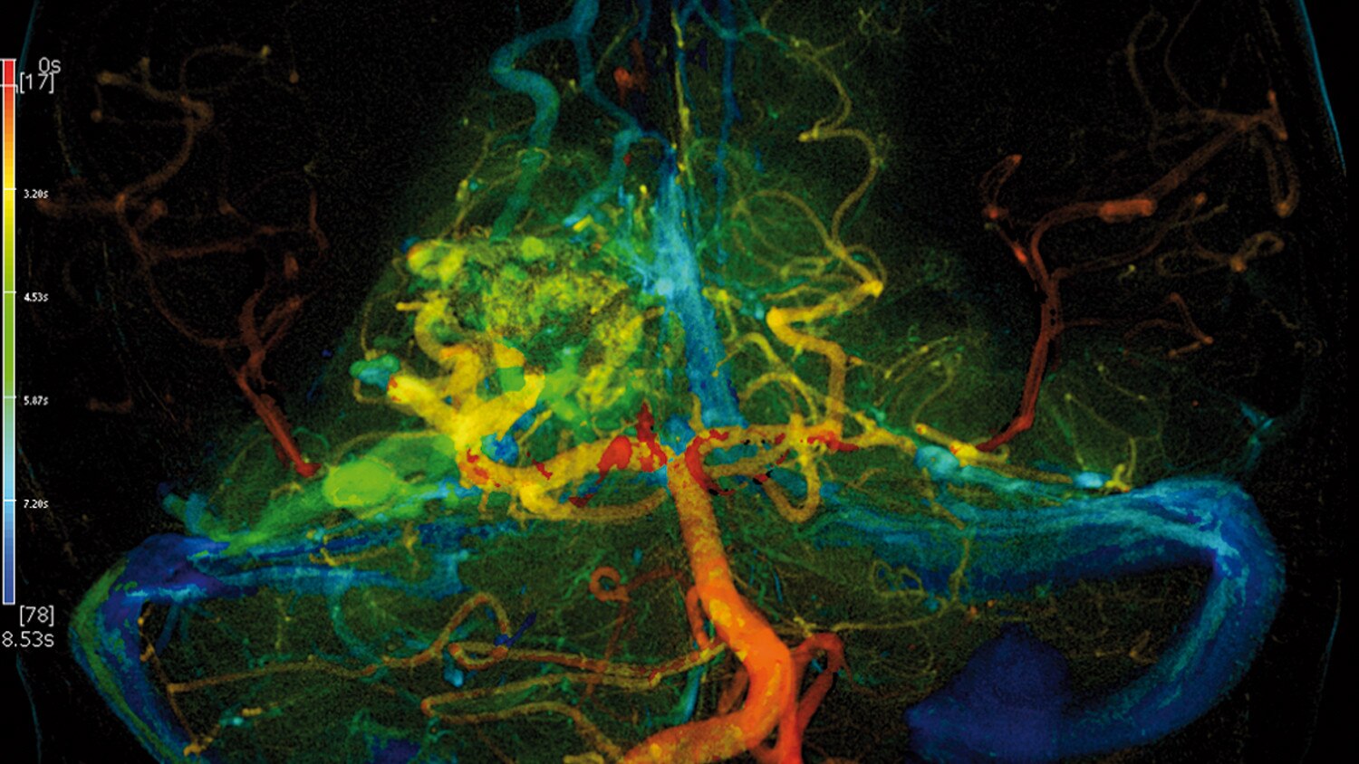 Neurology Advanced Visualization | GE HealthCare (Japan)